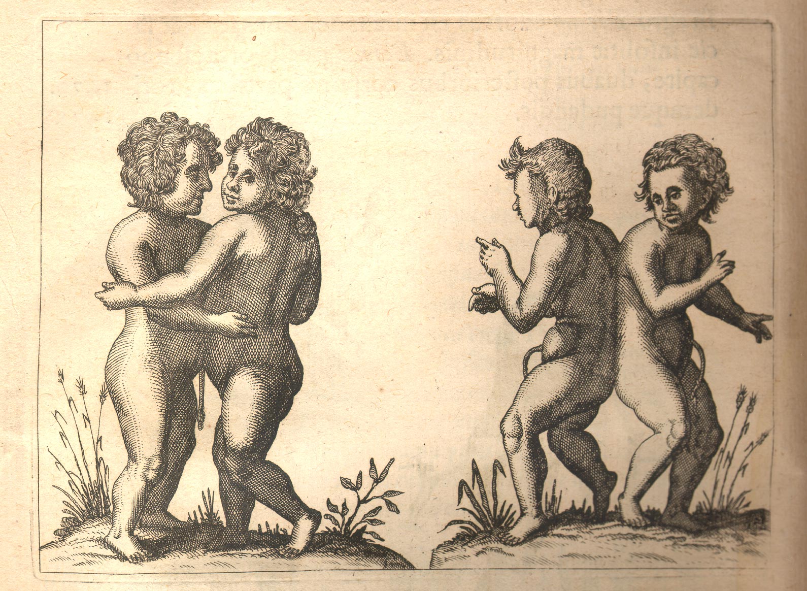 Siamese Twins, Ambroise Paré